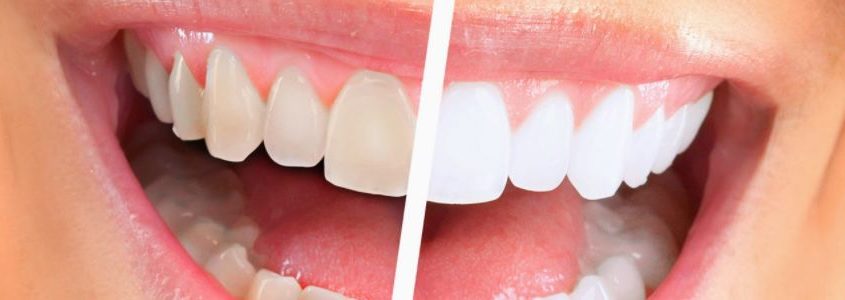 smalto_denti-845x300-1